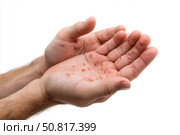 Human Hands with Painful Rash, Red Spots Blisters on the Skin. Health Problem. Monkeypox Disease Symptoms. Male Patient Arms with Monkey Pox. Close Up. Dengue Fever Infection, MPOX. Herpes, Pox Virus. Стоковое AI-изображение, AI-художник Марина Демидюк / Фотобанк Лори