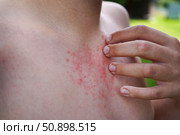 A boy rubs his hand over skin rashes resulting from allergies or hives. Skin conditions, dermatology. Стоковое фото, фотограф Ирина Старикова / Фотобанк Лори