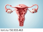 Illustration of a Uterus with Ovaries Highlighting the Structure and Potential Health Conditions Related to the Female Reproductive System. Стоковое AI-изображение, AI-художник Башкирова Анна / Фотобанк Лори