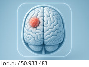 A Detailed Artistic Representation of a Human Brain with a Singular Tumor Highlighted, Emphasizing Neuroanatomy and Medical Visualization Techniques. Стоковое AI-изображение, AI-художник Башкирова Анна / Фотобанк Лори
