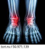 Ankle Fractures X-Ray Image Showing Both Feet and Lower Legs. Generative AI. Стоковое AI-изображение, AI-художник Roman Zavorotny / Фотобанк Лори
