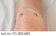 Close-up of a surgical suture on the knee after laparoscopic meniscus surgery. Стоковое фото, фотограф Михаил Решетников / Фотобанк Лори