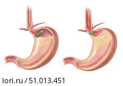 Normal closed pyloric valve and leaky valve with GERD. Стоковое фото, фотограф Elise Walmsley-MacWha/Stocktrek Images / ТАСС / Фотобанк Лори