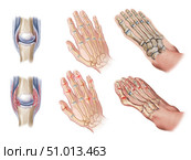 Detail of inflammed joints. Normal (top) vs. psoriatic hands and feet joints (bottom) Стоковое фото, фотограф Elise Walmsley-MacWha/Stocktrek Images / ТАСС / Фотобанк Лори