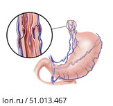 Esophageal varices on stomach and esophagus. Стоковое фото, фотограф Elise Walmsley-MacWha/Stocktrek Images / ТАСС / Фотобанк Лори