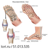 Top and side view of foot showing deformities caused by rheumatoid arthritis. Стоковое фото, фотограф Elise Walmsley-MacWha/Stocktrek Images / ТАСС / Фотобанк Лори