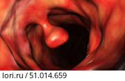 Illustrative close-up of a colon polyp. Стоковое фото, фотограф Stocktrek Images, Inc. / ТАСС / Фотобанк Лори