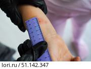 Closeup view photography of child's hand with red spot reaction to conducting Mantoux test after 72 hours from injection. Nurse in blue gloves applying transparent ruler to check reaction. Стоковое фото, фотограф Ирина Старикова / Фотобанк Лори
