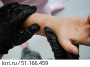 Detailed view of a child's hand with a red reaction following a Mantoux tuberculin test. Стоковое фото, фотограф Ирина Старикова / Фотобанк Лори