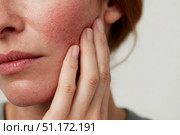 Sensitive skin. Woman scratches cheek with red rash, allergy symptom. Skin irritation, dermatitis, itchy skin problem. Face affected with Allergic reaction. Person suffering from itching, scratching. Стоковое AI-изображение, AI-художник Марина Демидюк / Фотобанк Лори