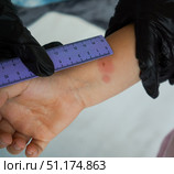 Macro shot of a child's hand showing a red bump after a Mantoux test. Стоковое фото, фотограф Ирина Старикова / Фотобанк Лори