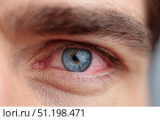 Human Eye with Conjunctivitis extreme close up. Closeup irritated infected red bloodshot eye. Male Eye. Vision. Eyesight. Adult Pain Eye Opening Wide. Viral infection with redness of eyeball. Macro. Стоковое фото, фотограф Марина Демидюк / Фотобанк Лори