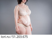 Diastasis recti, diastase of the rectus abdominis muscles, recovery after pregnancy, abdomen liposuction, fat and cellulite removal concept. Стоковое фото, фотограф Станислав Тарко / Фотобанк Лори