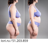 Tummy tuck, fat body before and after weight loss and liposuction on gray background, plastic surgery concept. Стоковое фото, фотограф Станислав Тарко / Фотобанк Лори