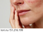 Sensitive skin. Woman scratches cheek with red rash, allergy symptom. Skin irritation, dermatitis, itchy skin problem. Face affected with Allergic reaction. Person suffering from itching, scratching. Стоковое AI-изображение, AI-художник Марина Демидюк / Фотобанк Лори