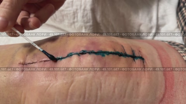 After the surgery, the stitched areas on the body are covered with Betadine antiseptic. Medical surgical care. Close-up. Стоковое видео, видеограф Ирина Старикова / Фотобанк Лори