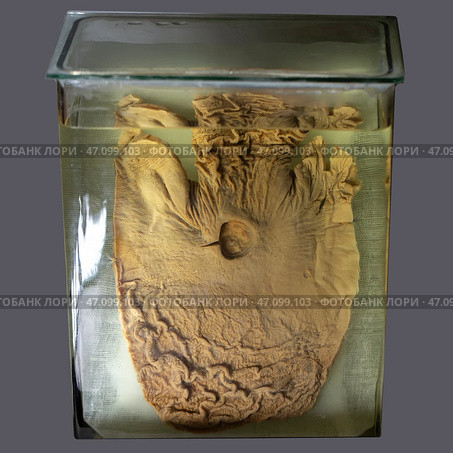 April 1, 2023. Belarus, Minsk. Exhibition of anatomical exhibits. The stomach organ of a person with a perforated ulcer is an anatomical exhibit preserved in alcohol in a formaldehyde solution. Редакционное фото, фотограф Лазаренко Светлана / Фотобанк Лори