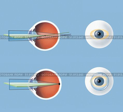 Astigmatism and correction with corrective lens. Стоковое фото, фотограф Elise Walmsley-MacWha/Stocktrek Images / ТАСС / Фотобанк Лори