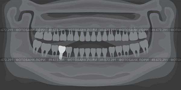 Black and white x-ray of human jaw with normal teeth and dental implant. Tooth after dental procedure. Surgical implant in oral cavity. Treatment, dentistry, health care. Radiograph with prosthesis. X-ray of human jaw with normal teeth and dental implant. Radiograph with prosthesis in gum. Стоковая иллюстрация, агентство Ingram Publishing / Фотобанк Лори