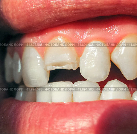 Broken tooth. Broken upper incisor in a man mouth. Стоковое фото, фотограф Леонид Еремейчук / Фотобанк Лори