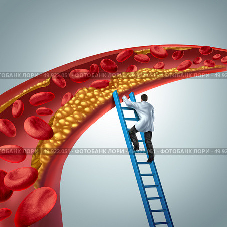 Cholesterol medical diagnosis concept as a doctor investigating atherosclerosis or arterial plaque clogging an artery with 3D render elements. Стоковое фото, агентство Ingram Publishing / Фотобанк Лори