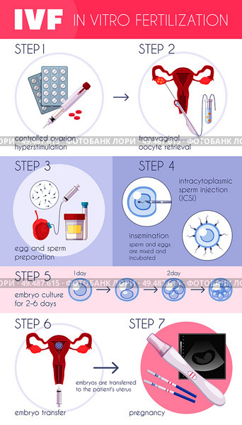 Colored flat in vitro fertilization IVF  infographics with steps for pregnancy progress vector illustration. Стоковая иллюстрация, агентство Ingram Publishing / Фотобанк Лори