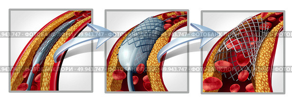 Coronary stent and angioplasty concept as a heart disease treatment symbol diagram with the stages of an implant procedure in an artery that has cholesterol plaque blockage being opened for increased blood flow as a 3D illustration. Стоковое фото, агентство Ingram Publishing / Фотобанк Лори