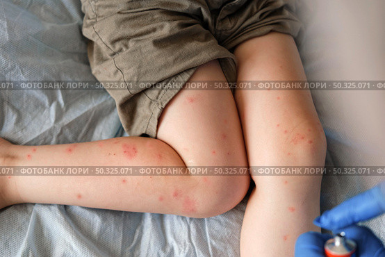 Doctor examining child with bodily red rash. Kid allergy closeup. Little baby scratches an eruption. Nurse applies special cream to atopic skin. Dermatitis, irritation, hive. Pruritus. Mosquito bites. Стоковое фото, фотограф Марина Демидюк / Фотобанк Лори