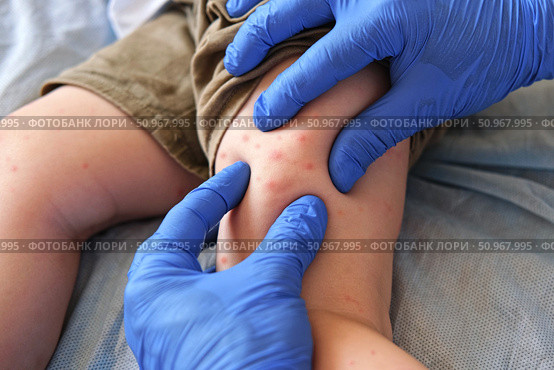 Doctor examining child with bodily red rash. Kid allergy closeup. Little baby scratches an eruption. Nurse applies special cream to atopic skin. Dermatitis, irritation, hive. Pruritus. Mosquito bites. Стоковое фото, фотограф Марина Демидюк / Фотобанк Лори