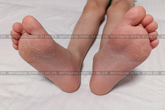 Dry feet peeling skin on feet. Air allergy, chemical allergy. Dermatitis. Eczema. Dyshidrosis. Baby feet. White background. Стоковое фото, фотограф Екатерина Топорова / Фотобанк Лори