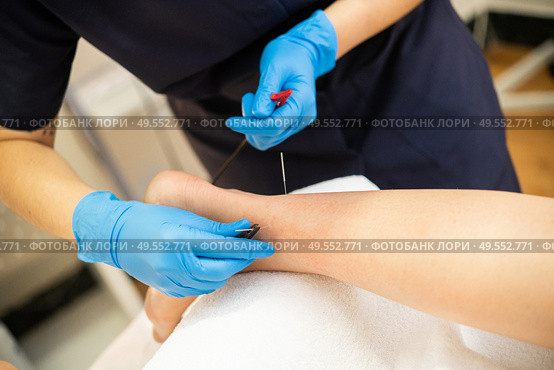 Electro-acupuncture dry with needle connecting machine. Electro stimulation in physical therapy.. Electro acupuncture dry with needle connecting machine. Стоковое фото, агентство Ingram Publishing / Фотобанк Лори