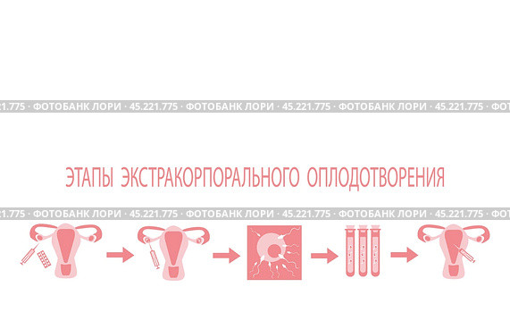 Этапы экстракорпорального оплодотворения, схема ЭКО. Стоковая иллюстрация, иллюстратор Юлия Королева / Фотобанк Лори