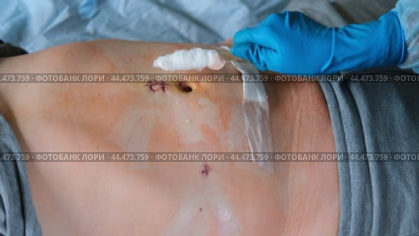 Hands of medic or nurse in blue gloves examining a fresh suture on a male stomach after laparoscopy surgical removal of appendicitis. Doctor examines of the patient. Man belly with medical stitches. Стоковое видео, видеограф Марина Демидюк / Фотобанк Лори
