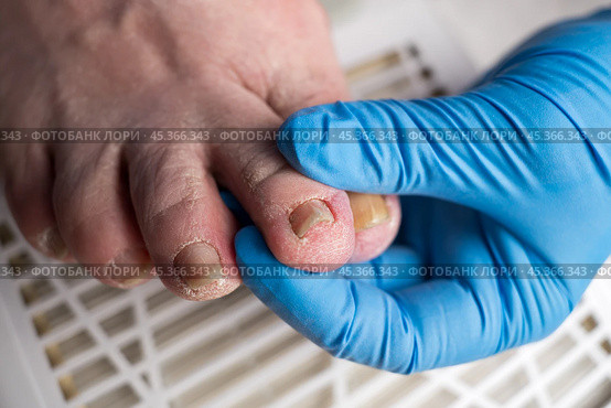 Hardware pedicure, ingrown toenail, elderly woman with cracked skin on her foot at a podiatrist's appointment, chiropody and podology concept. Стоковое фото, фотограф Станислав Тарко / Фотобанк Лори