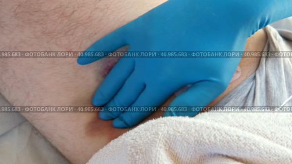 Hematoma on a men's leg close-up. Huge bruise on the leg of a man after endovascular repair due to taking blood thinning medication drugs. Doctor's hand in blue gloves examining patient. Hemorrhage. Стоковое видео, видеограф Марина Демидюк / Фотобанк Лори