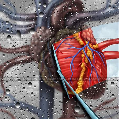 Human heart disease therapy as a cardiac health and cardiovascular medical concept with a wiper wiping clean and removing a sick blurry organ as a cure and treatment symbol for cardiologist or surgeon with 3D illustration elements. Стоковое фото, агентство Ingram Publishing / Фотобанк Лори