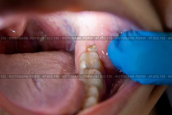 Impacted wisdom tooth with gum hood, jaw inflammation, teeth extraction, dentistry concept. Стоковое фото, фотограф Станислав Тарко / Фотобанк Лори