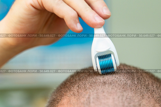 Man with early-stage baldness using a microneedling roller with sharp needles for scalp massage and hair regrowth treatment. Стоковое фото, фотограф Татьяна Степанищева / Фотобанк Лори