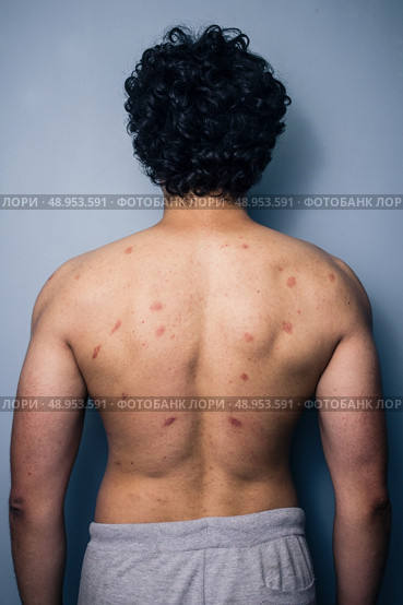 Man with mosquito bites on his back. Стоковое фото, агентство Ingram Publishing / Фотобанк Лори