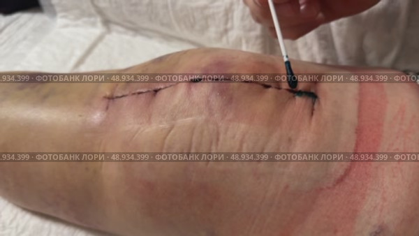 Medical sutures, stitch after surgery, stitched surgical sutures on human body smeared betadine. Medical surgical care. Close-up. Стоковое видео, видеограф Ирина Старикова / Фотобанк Лори
