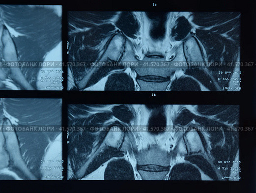 MRI sacroiliac articulation. Study of ankylosing spondyloarthritis patient. Стоковое фото, фотограф Леонид Еремейчук / Фотобанк Лори