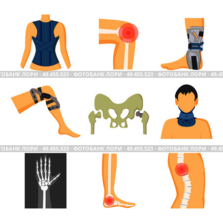 Orthopedics fixing tools and pain in bones image, color vector illustration with medical retainers on legs neck back, different human s skeleton parts. Orthopedics Fixing Tools and Pain in Bones Image. Стоковая иллюстрация, агентство Ingram Publishing / Фотобанк Лори