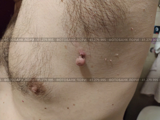 Papillomas on the skin - one red dying off in the axillary region and several small neoplasms. Human viral infections. Стоковое фото, фотограф Юлия Петровская / Фотобанк Лори