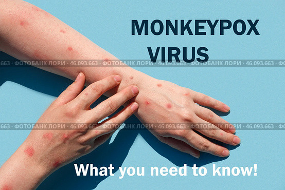 Phrase MONKEYPOX VIRUS what you need to know. Monkeypox new disease dangerous over the world. Patient with Monkey Pox. Painful rash, red spots blisters. Close up human hands with Health problem. Стоковое фото, фотограф Марина Демидюк / Фотобанк Лори