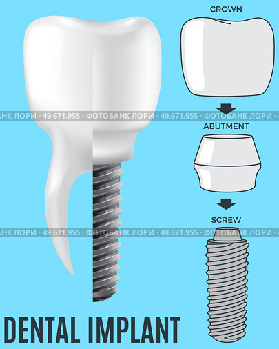 Realistic white dental implant and human tooth. Dentistry, medicine and oral cavity health concept. Denture construction, dental prosthesis structure. Information banner about teeth and implants. Realistic white dental implant and human tooth. Dentistry, medicine and oral cavity health. Стоковая иллюстрация, агентство Ingram Publishing / Фотобанк Лори