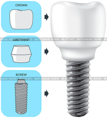 Realistic white dental implant and human tooth. Dentistry, medicine and oral cavity health concept. Denture construction, dental prosthesis structure. Information banner about teeth and implants. Realistic white dental implant and human tooth. Dentistry, medicine and oral cavity health. Стоковая иллюстрация, агентство Ingram Publishing / Фотобанк Лори
