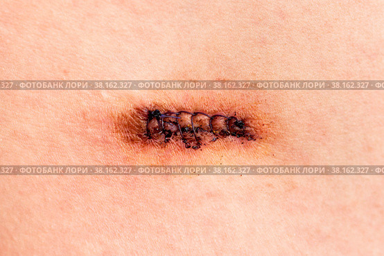 Row of stitches holding together the edges of a wound. Стоковое фото, фотограф Nobilior / Фотобанк Лори