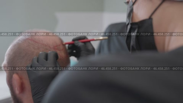 Scalp Micropigmentation Procedure in Progress at a Professional Aesthetic Clinic Today. Стоковое видео, видеограф Михаил Матвеев / Фотобанк Лори