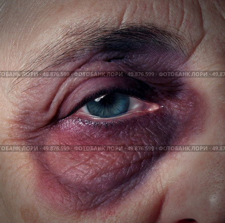 Senior abuse or elder mistreatment as an old person with a black eye bruised and injured from domestic violence on older aging adults fromn a retirement home or caretaker who has broken the trust as a legal health care concept. Стоковое фото, агентство Ingram Publishing / Фотобанк Лори