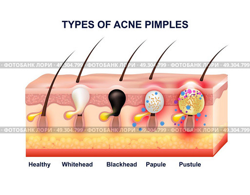 Skin Acne Anatomy Composition. Colored skin acne anatomy composition with types of acne pimples before and after vector illustration. Стоковая иллюстрация, агентство Ingram Publishing / Фотобанк Лори